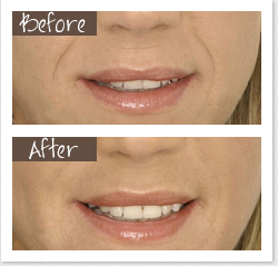 Dermal Fillers