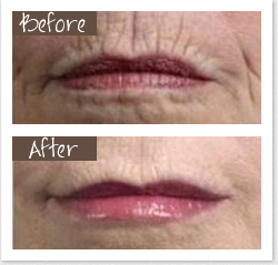 Dermal Fillers