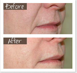 Dermal Fillers